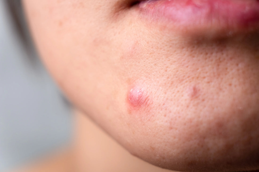 podkozhni-pupki-woman-with-sebaceous-pimples-on-chin