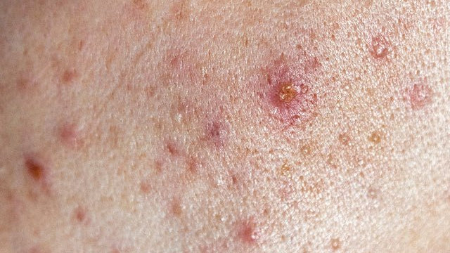 Козметични съставки, които помагат при акне - Al+ Cosmetics