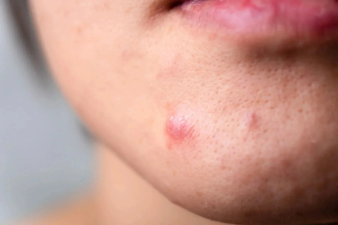 Подкожни пъпки: Защо се появяват и как може да се справим с тях? - Al+ Cosmetics