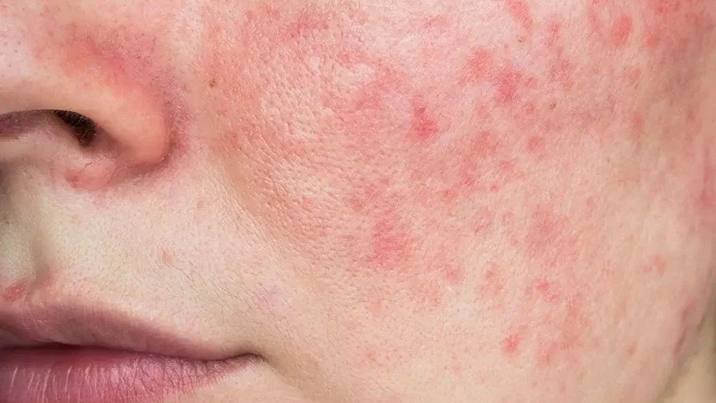 Розацея - причини, симптоми и методи за лечение - Al+ Cosmetics