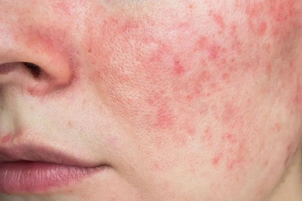 Розацея - причини, симптоми и методи за лечение - Al+ Cosmetics