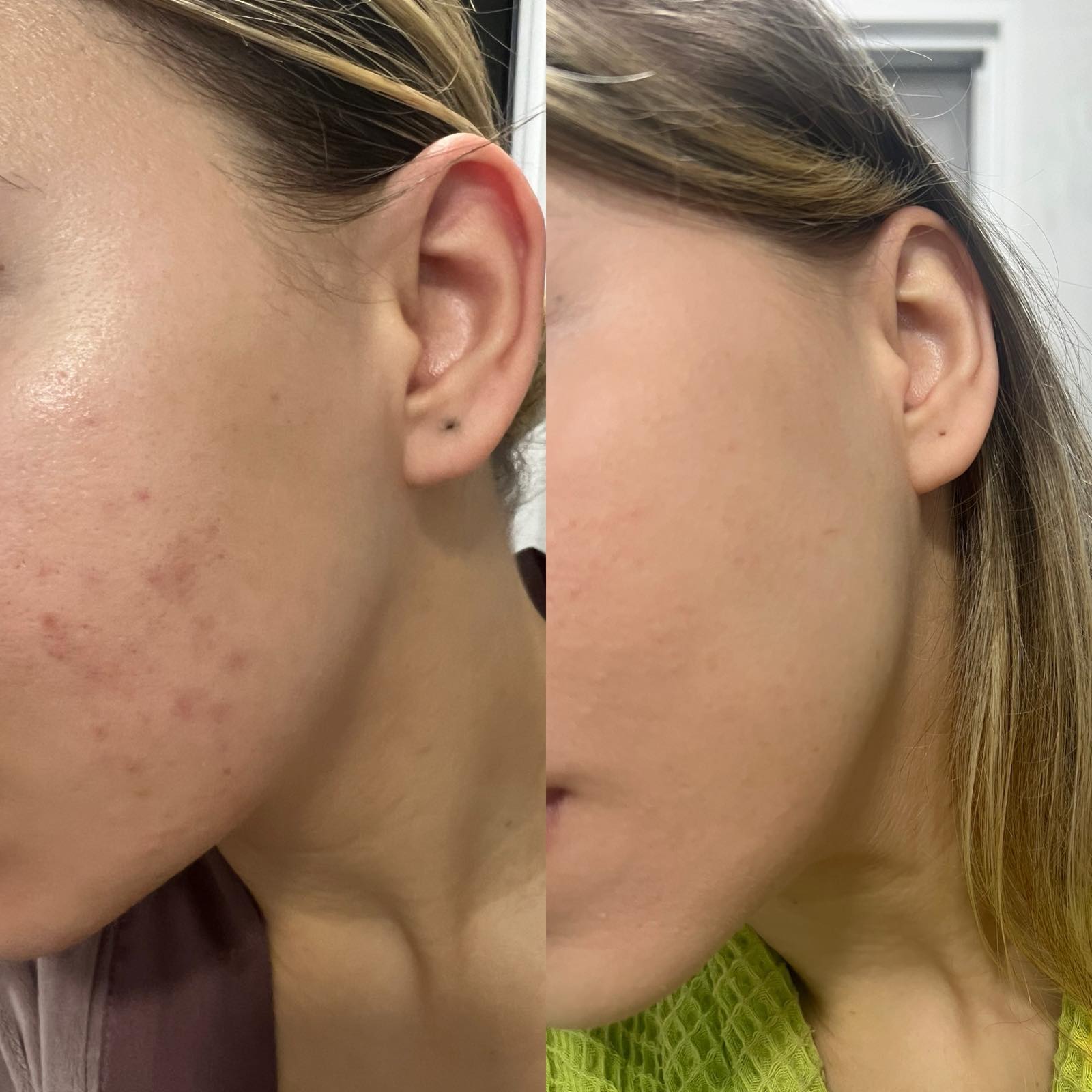 Redness Calm+ | Рутина за зачервяване и чувствителност