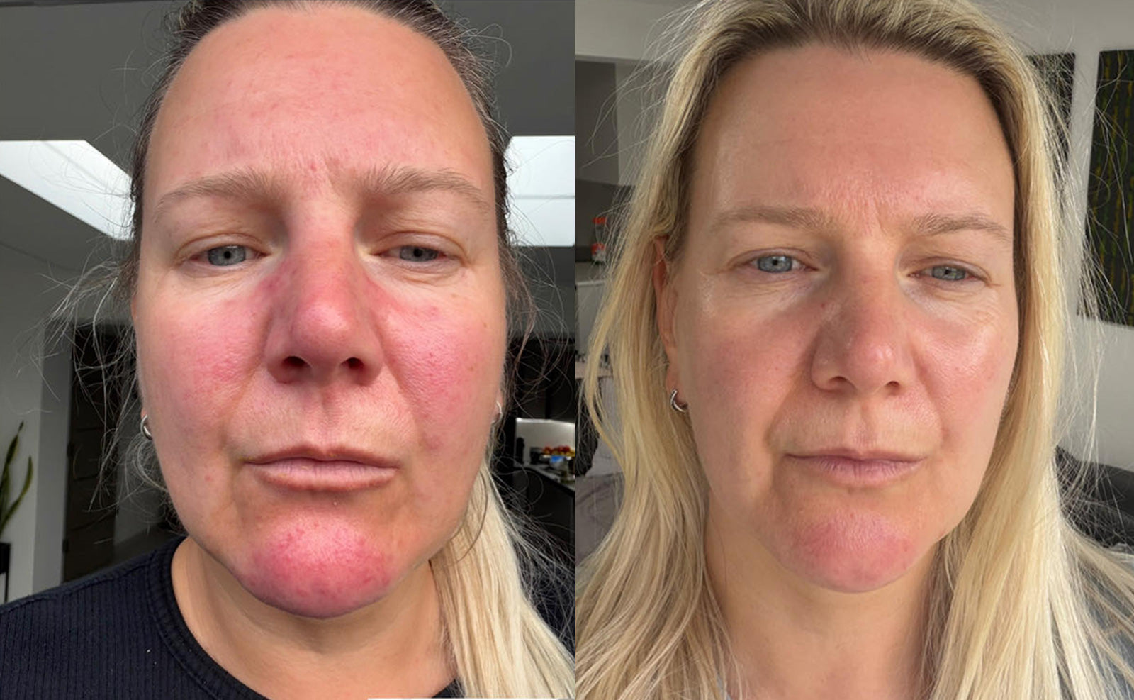 Redness Calm+ | Рутина за зачервяване и чувствителност