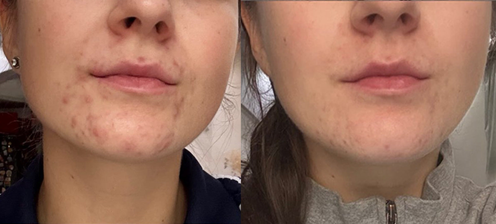 Redness Calm+ | Рутина за зачервяване и чувствителност